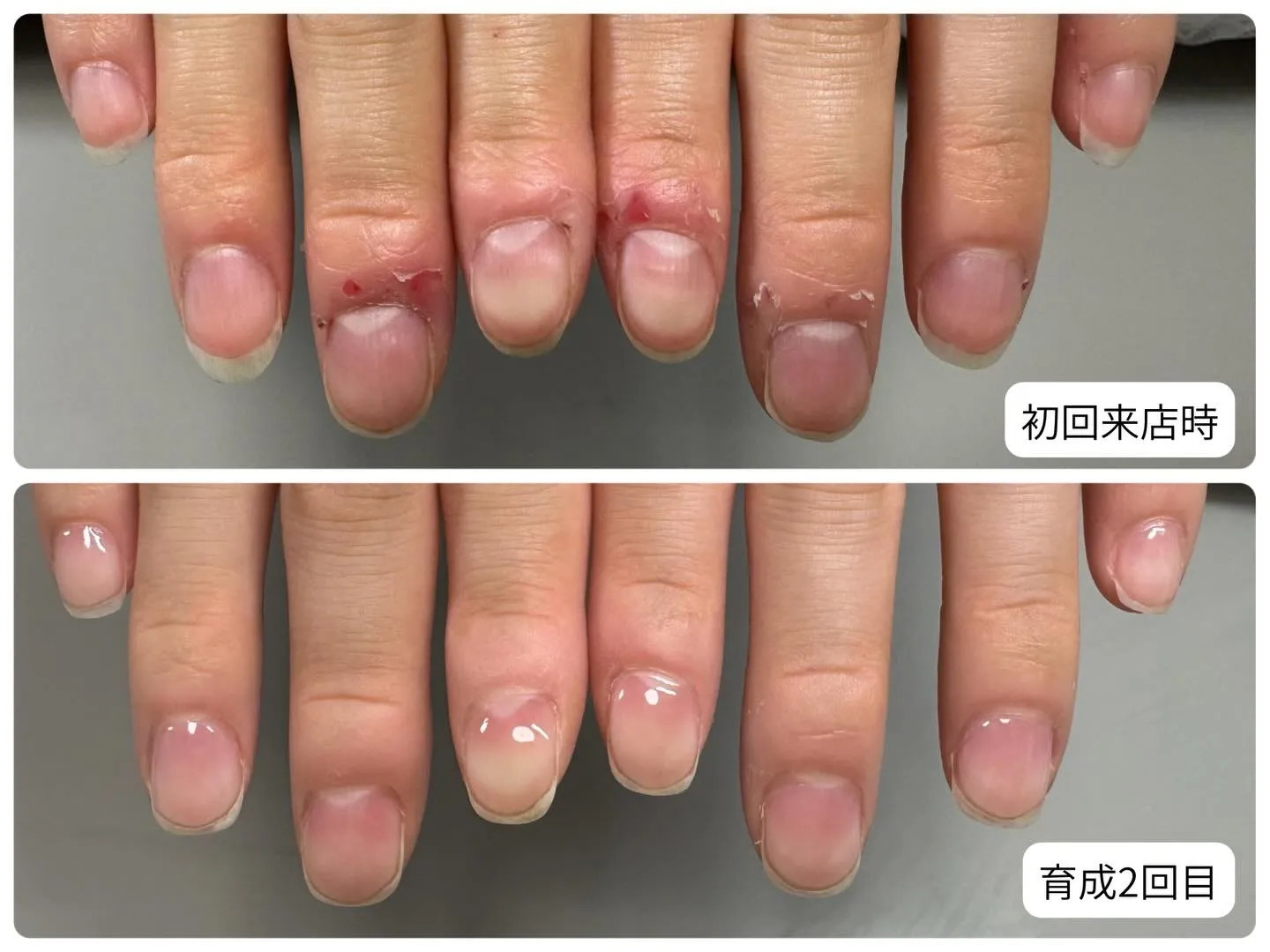 約3週間でささくれがこんなに綺麗になりました✨