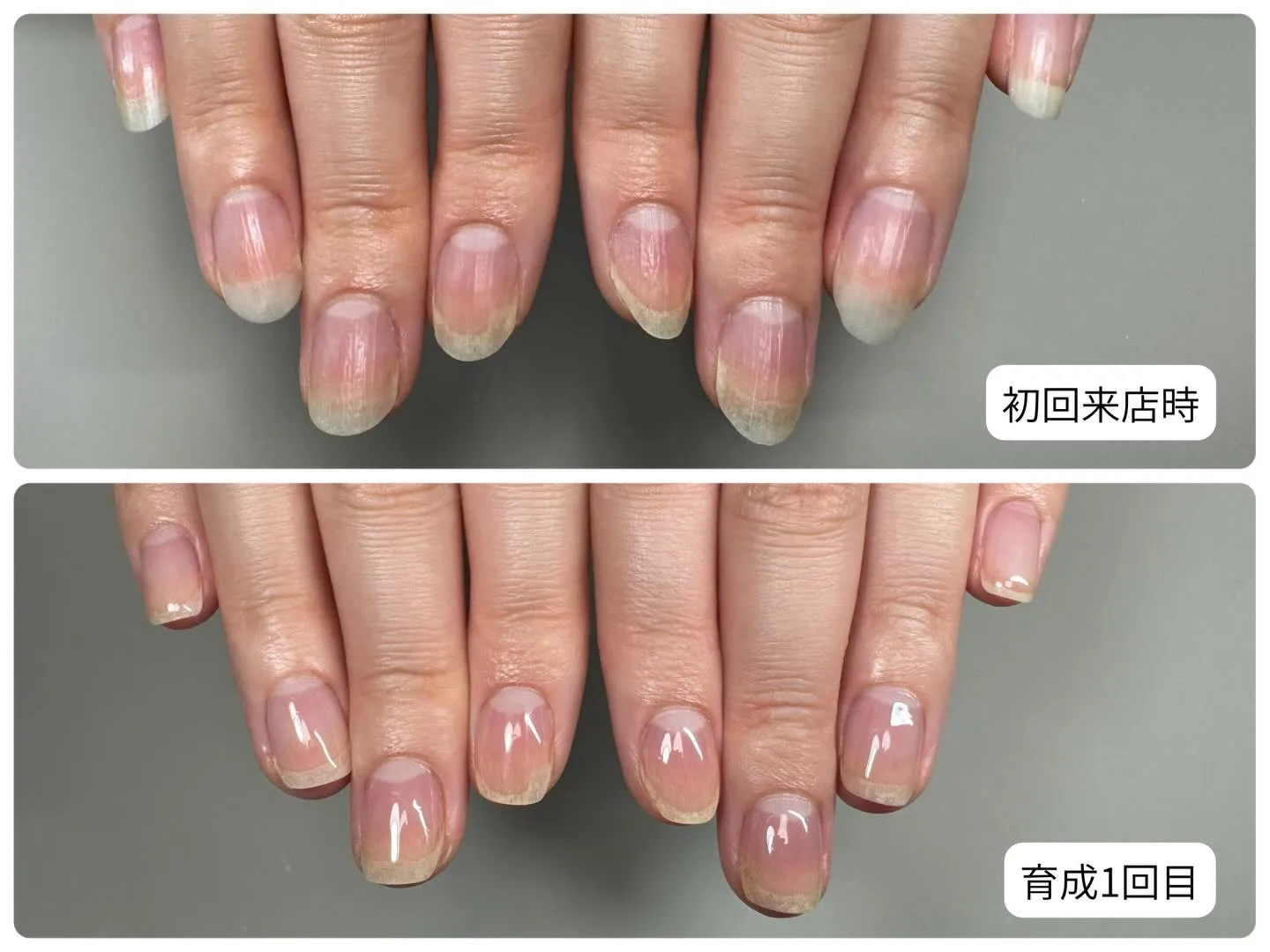 10年以上爪の剥離でお悩みのお客様。